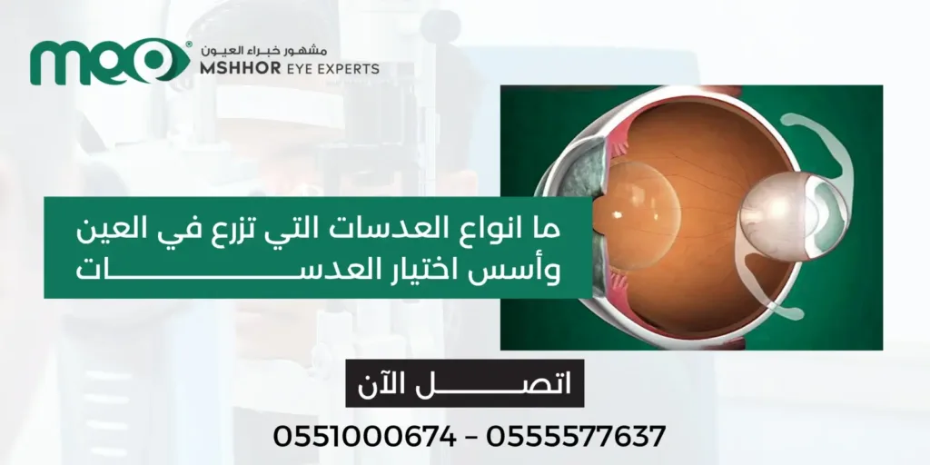 انواع العدسات التي تزرع في العين