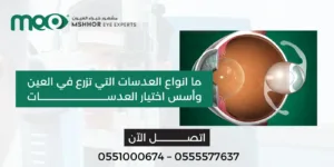 انواع العدسات التي تزرع في العين