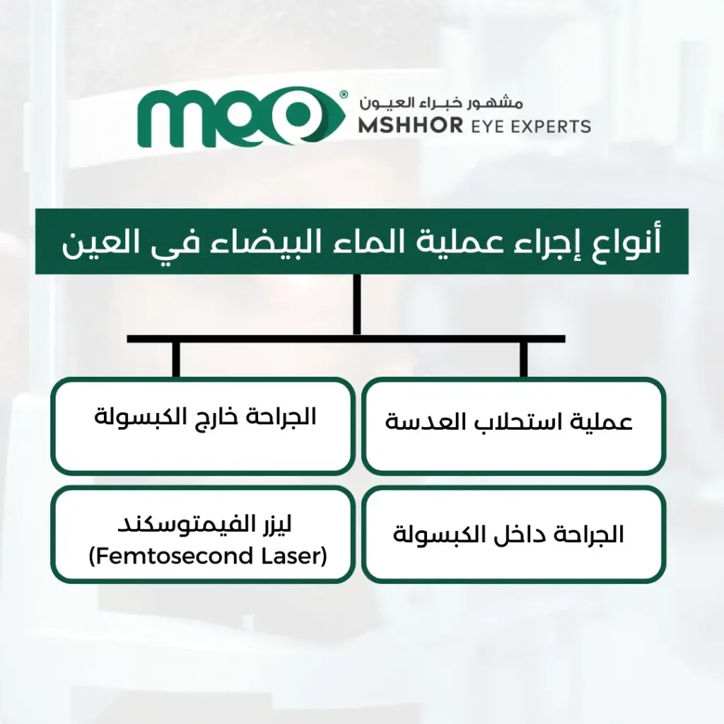 عملية الماء البيضاء في العين