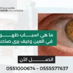 اسباب الماء الابيض في العين