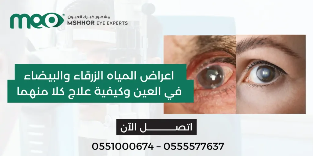 اعراض المياه الزرقاء والبيضاء في العين