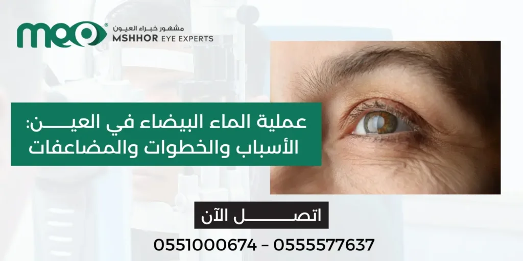 عملية الماء البيضاء في العين