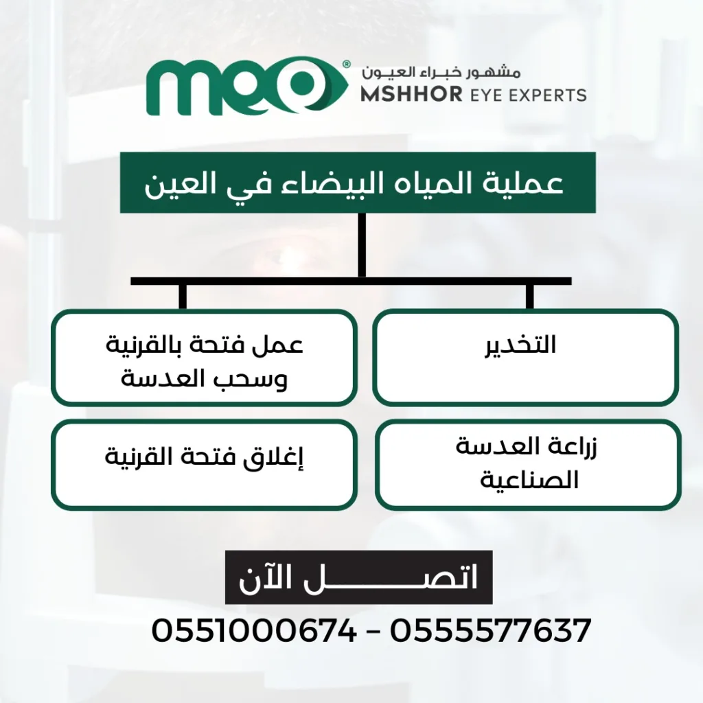 اسباب ظهور الماء الابيض في العين