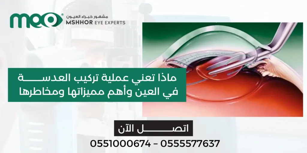 تركيب العدسة في العين