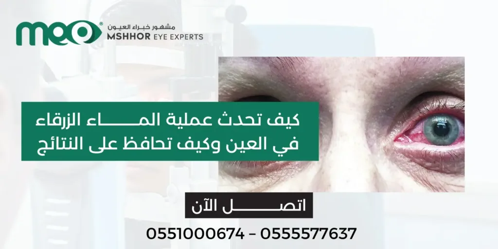 عملية الماء الزرقاء في العين