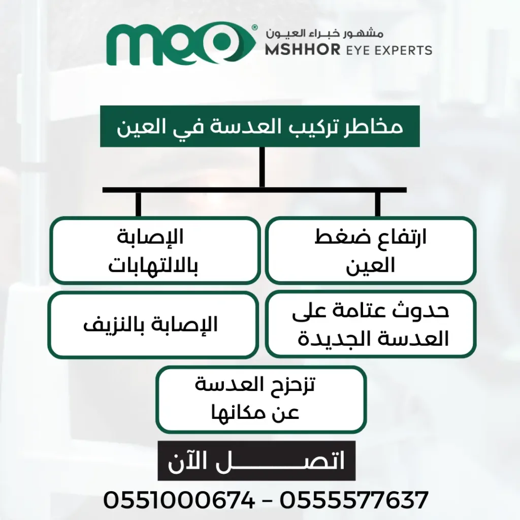 تركيب العدسة في العين