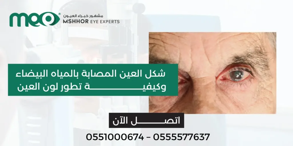 شكل العين المصابة بالمياه البيضاء