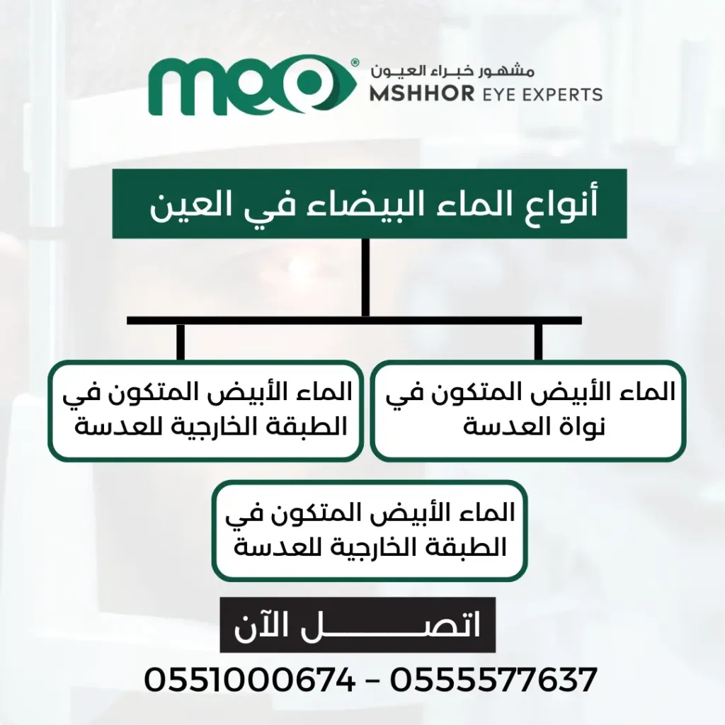 شكل العين المصابة بالمياه البيضاء