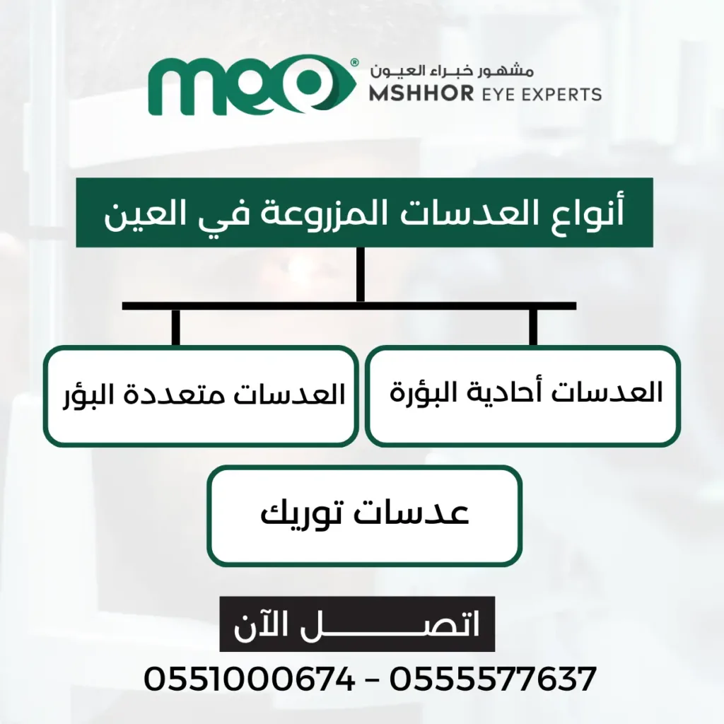 عملية زراعة العدسة لضعف النظر الشديد