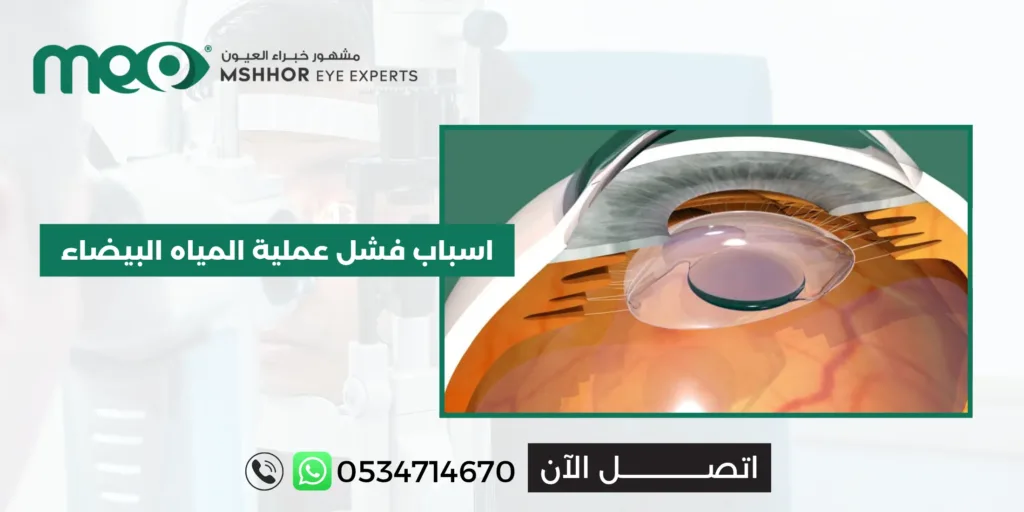 اسباب فشل عملية المياه البيضاء