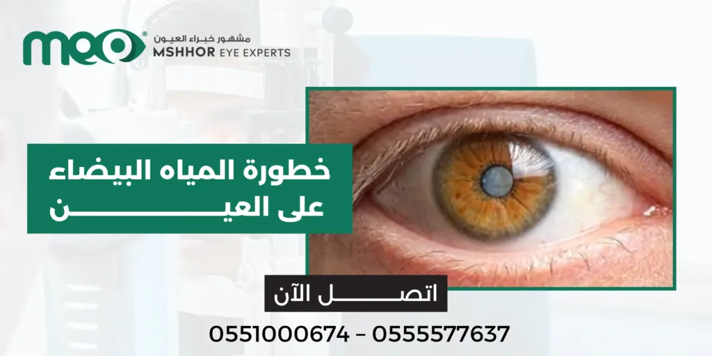 خطورة المياه البيضاء على العين