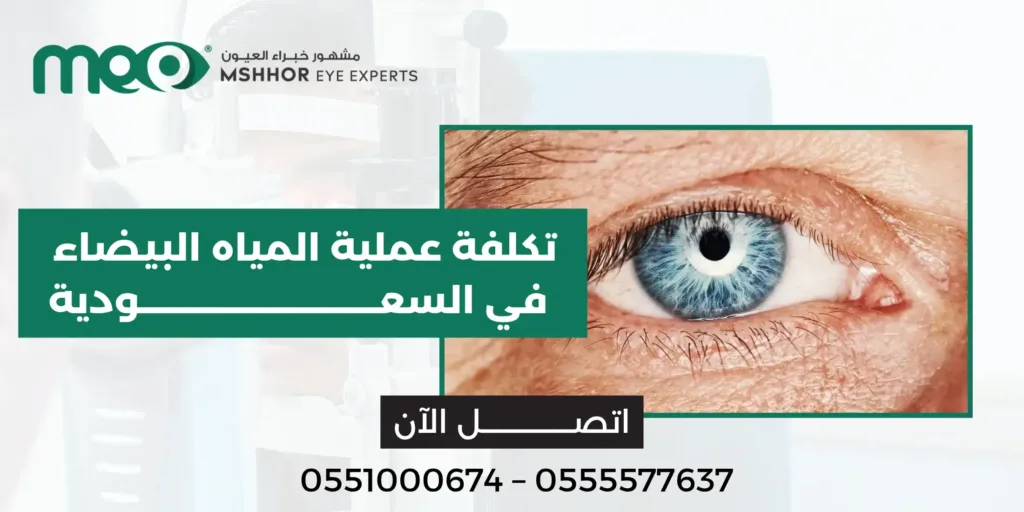 تكلفة عملية المياه البيضاء في السعودية