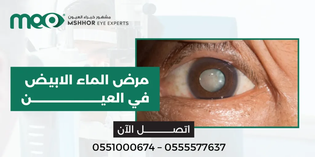 مرض الماء الابيض في العين