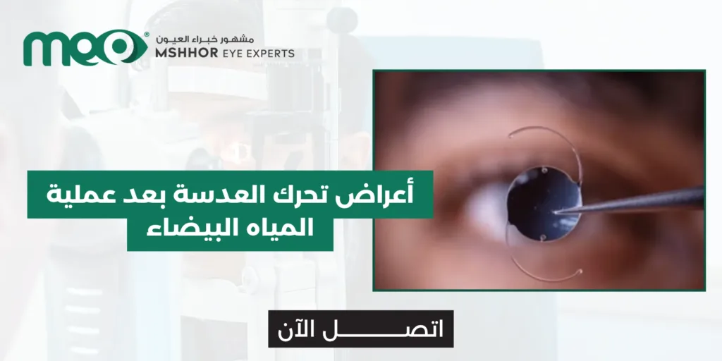أعراض تحرك العدسة بعد عملية المياه البيضاء