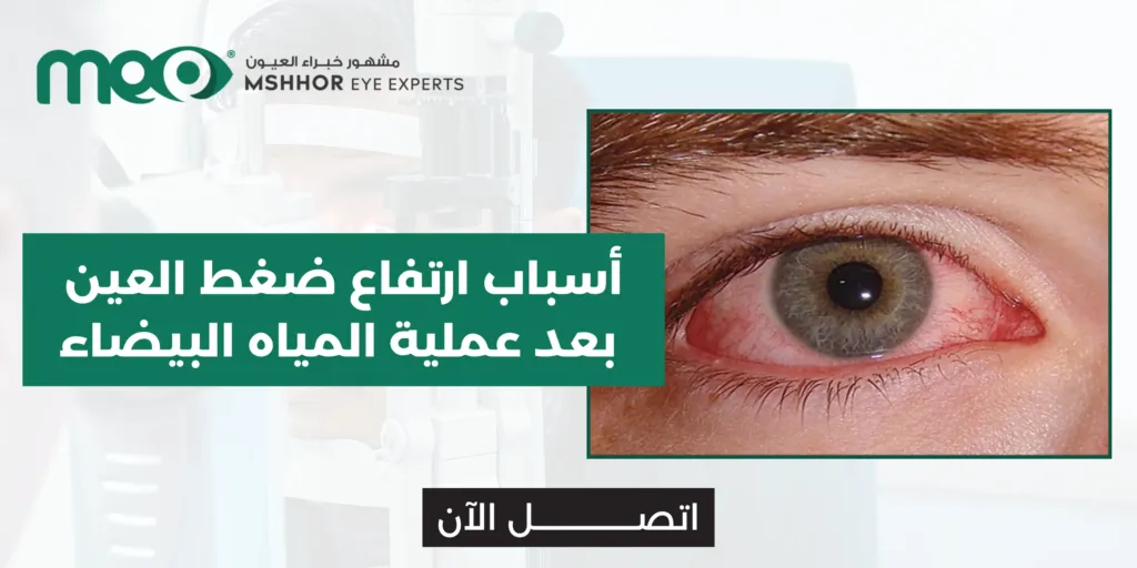 أسباب ارتفاع ضغط العين بعد عملية المياه البيضاء