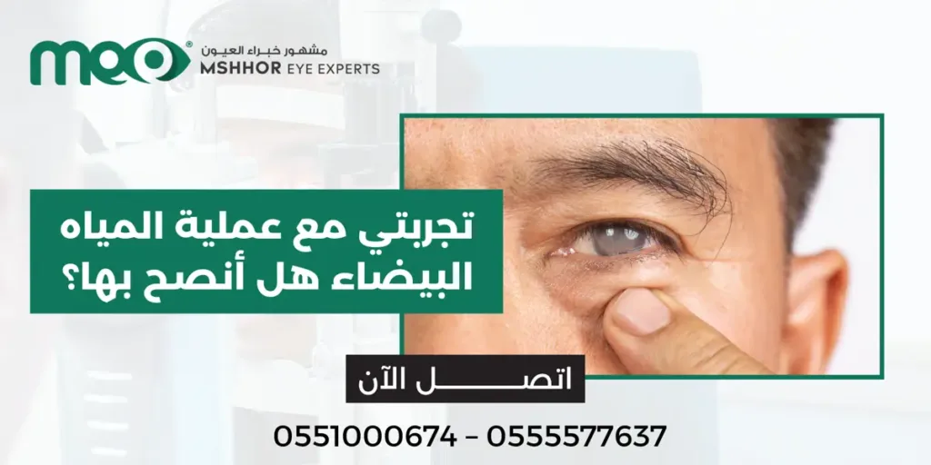 تجربتي مع عملية المياه البيضاء
