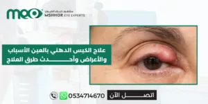 علاج الكيس الدهني بالعين