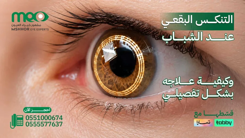 التنكس البقعي عند الشباب