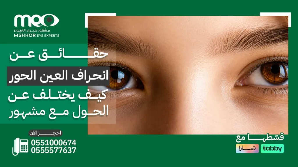 انحراف العين الحور