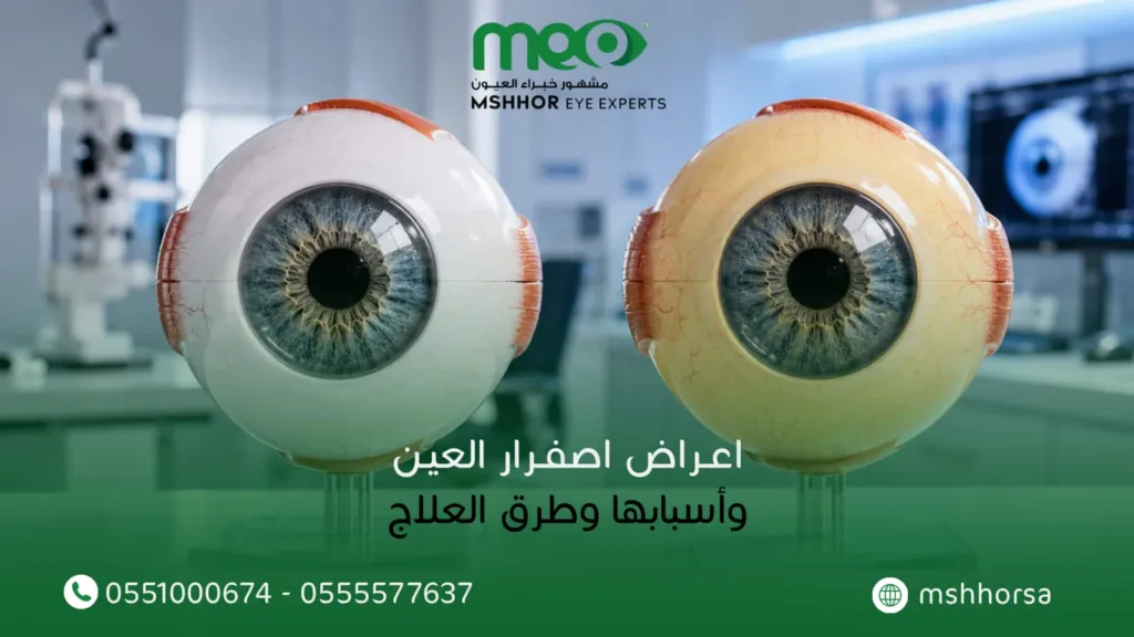 اعراض اصفرار العين