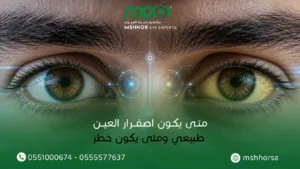 متى يكون اصفرار العين طبيعي