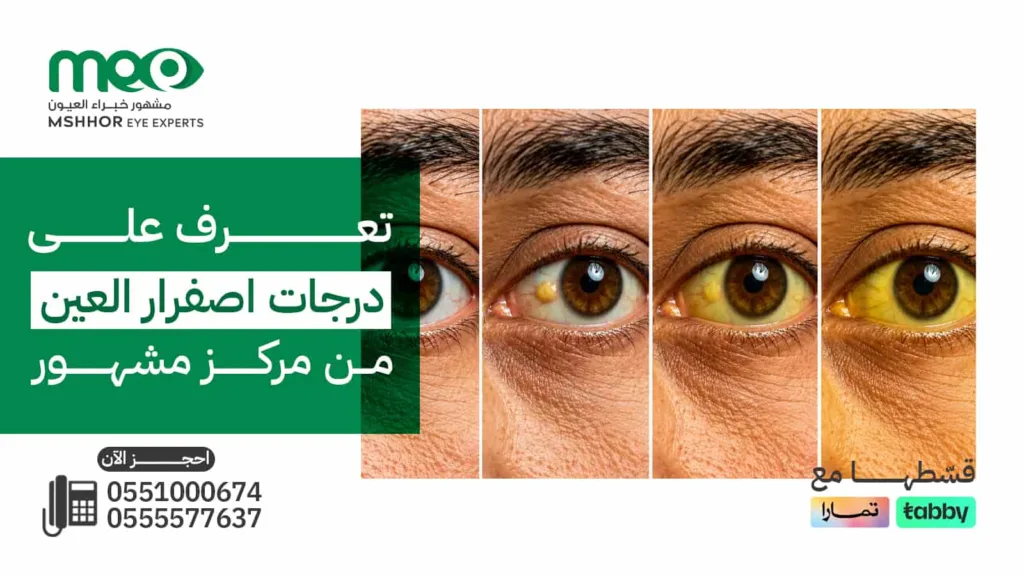درجات اصفرار العين