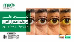 درجات اصفرار العين