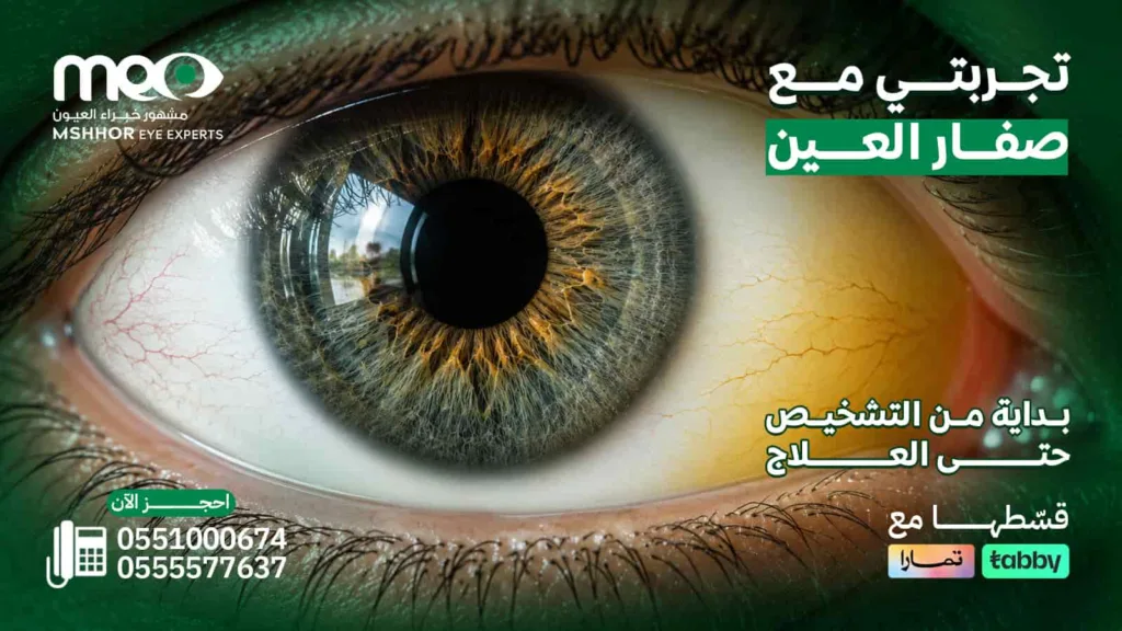 تجربتي مع صفار العين
