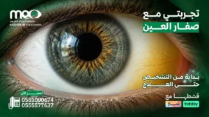تجربتي مع صفار العين