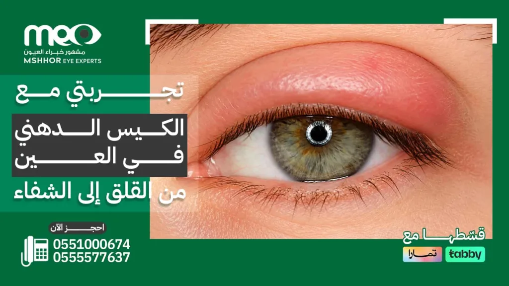 تجربتي مع الكيس الدهني في العين