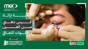 عملية ازالة كيس دهني من جفن العين