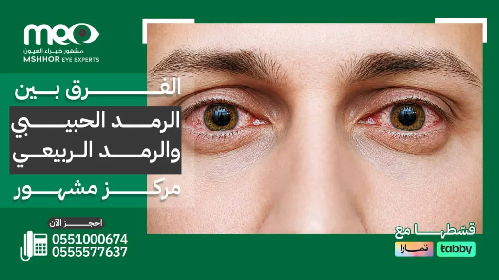 الفرق بين الرمد الحبيبي والرمد الربيعي