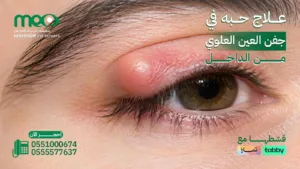علاج حبه في جفن العين العلوي من الداخل