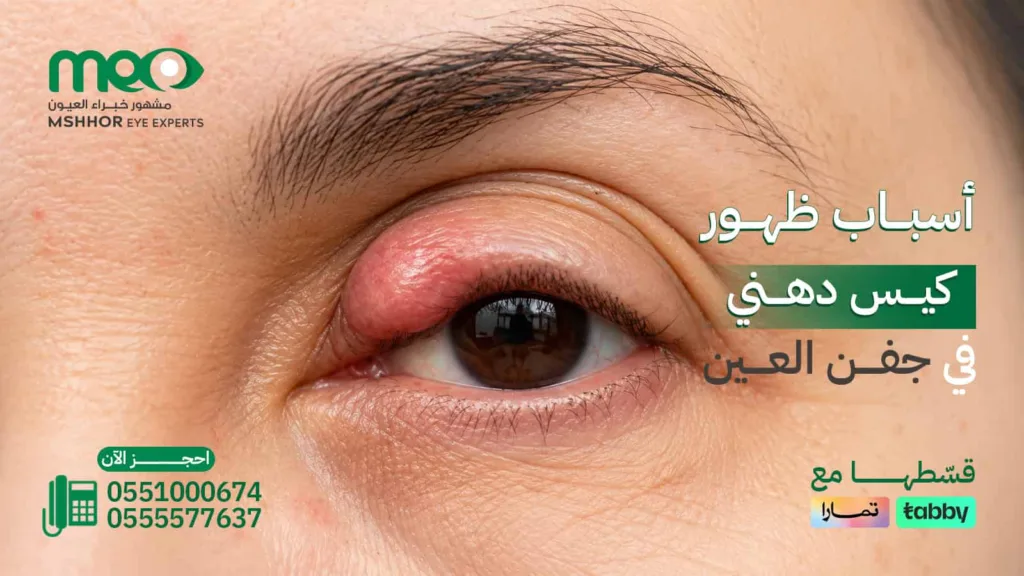 كيس دهني في جفن العين