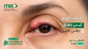 كيس دهني في جفن العين