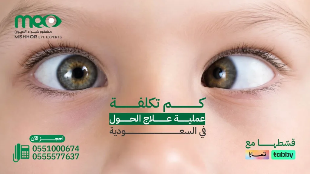 تكلفة عملية علاج الحول في السعودية