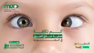 تكلفة عملية علاج الحول في السعودية
