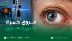 عروق حمراء في العين